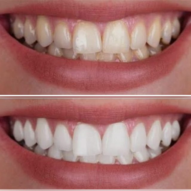 Patient 1: teeth before (top) and after (bottom) whitening