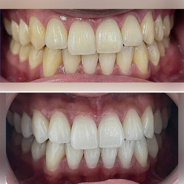 Patient 2: teeth before (top) and after (bottom) whitening