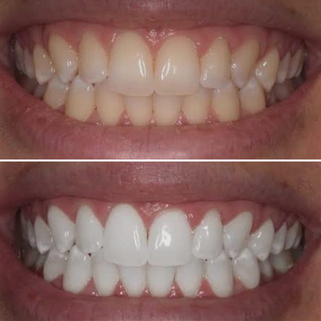 Patient 3: teeth before (top) and after (bottom) whitening