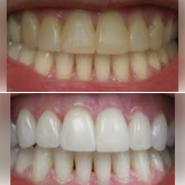 Patient 4: teeth before (top) and after (bottom) whitening