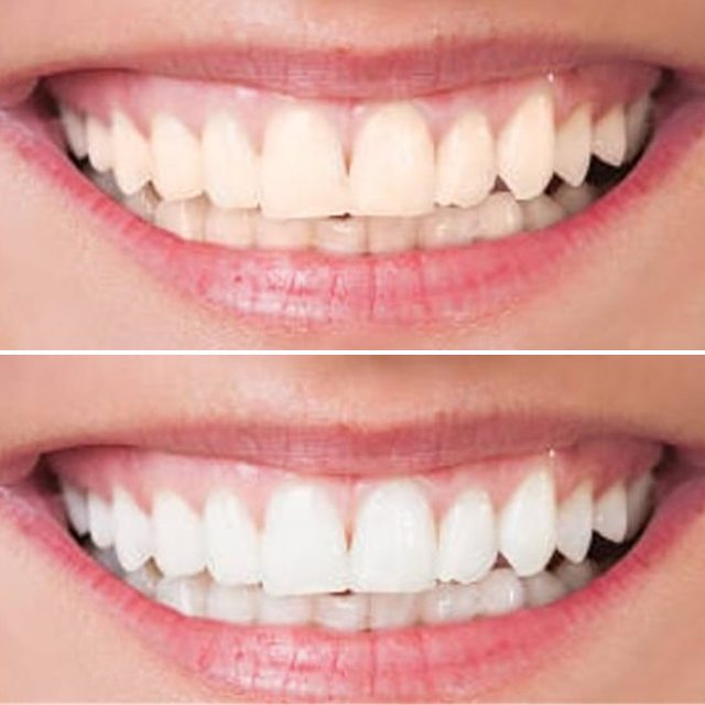 Patient 5: teeth before (top) and after (bottom) whitening