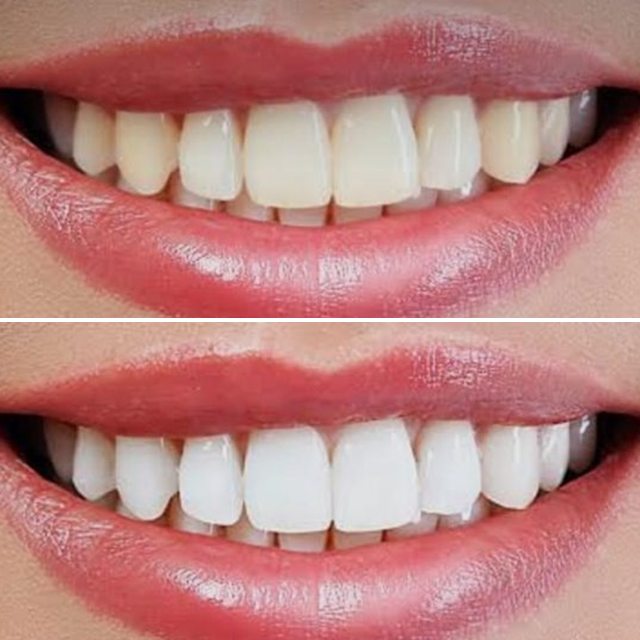 Patient 6: teeth before (top) and after (bottom) whitening