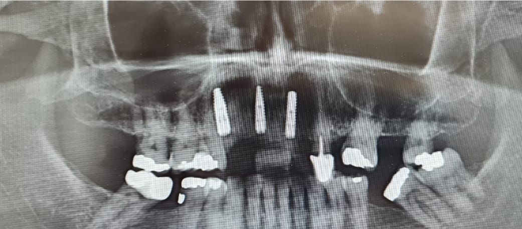 Dental Implants