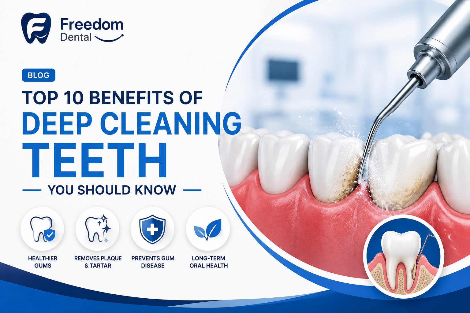 Top 10 Benefits of Deep Cleaning Teeth You Should Know