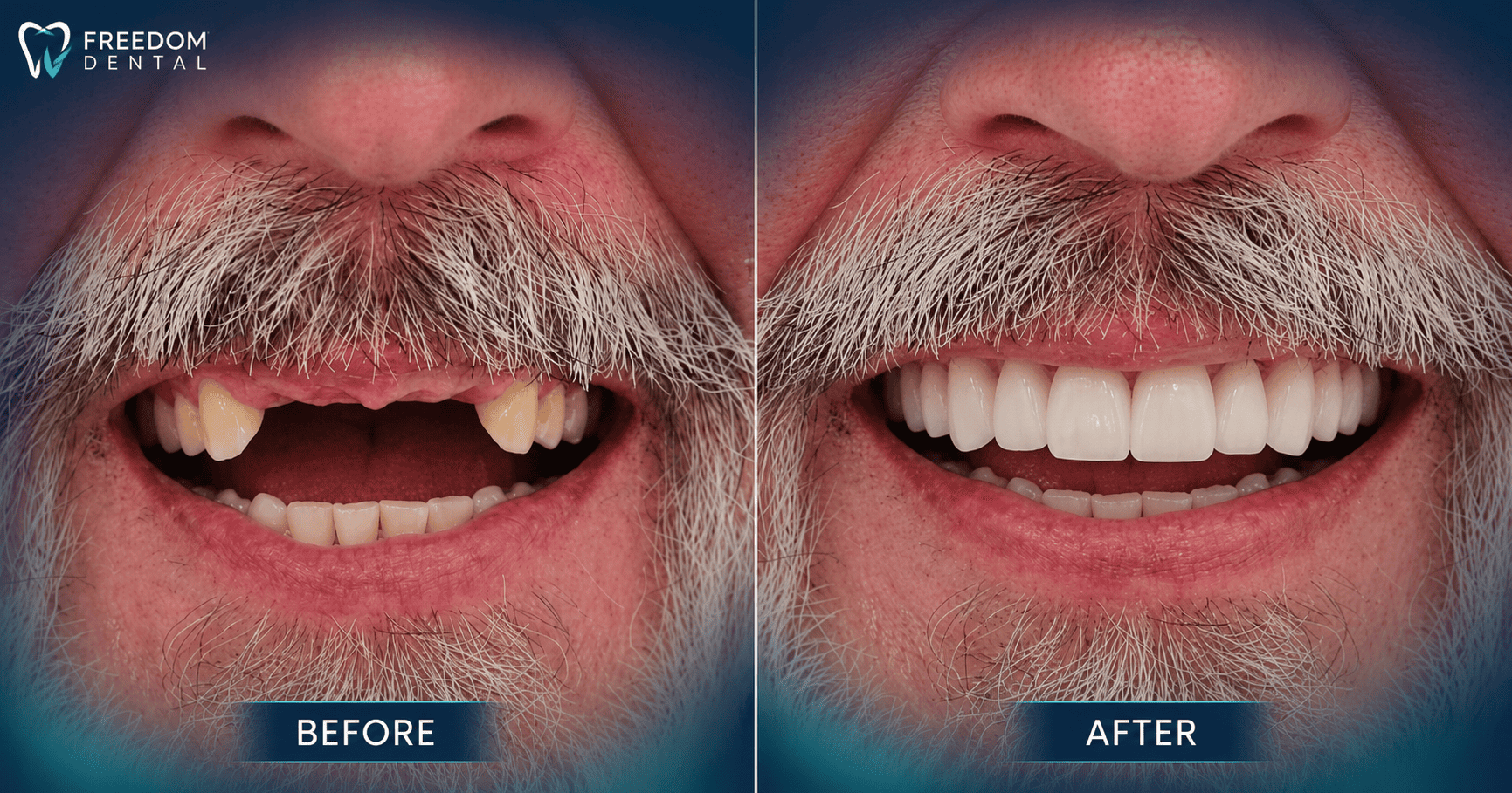 Treating Missing Front Teeth with Dental Implants