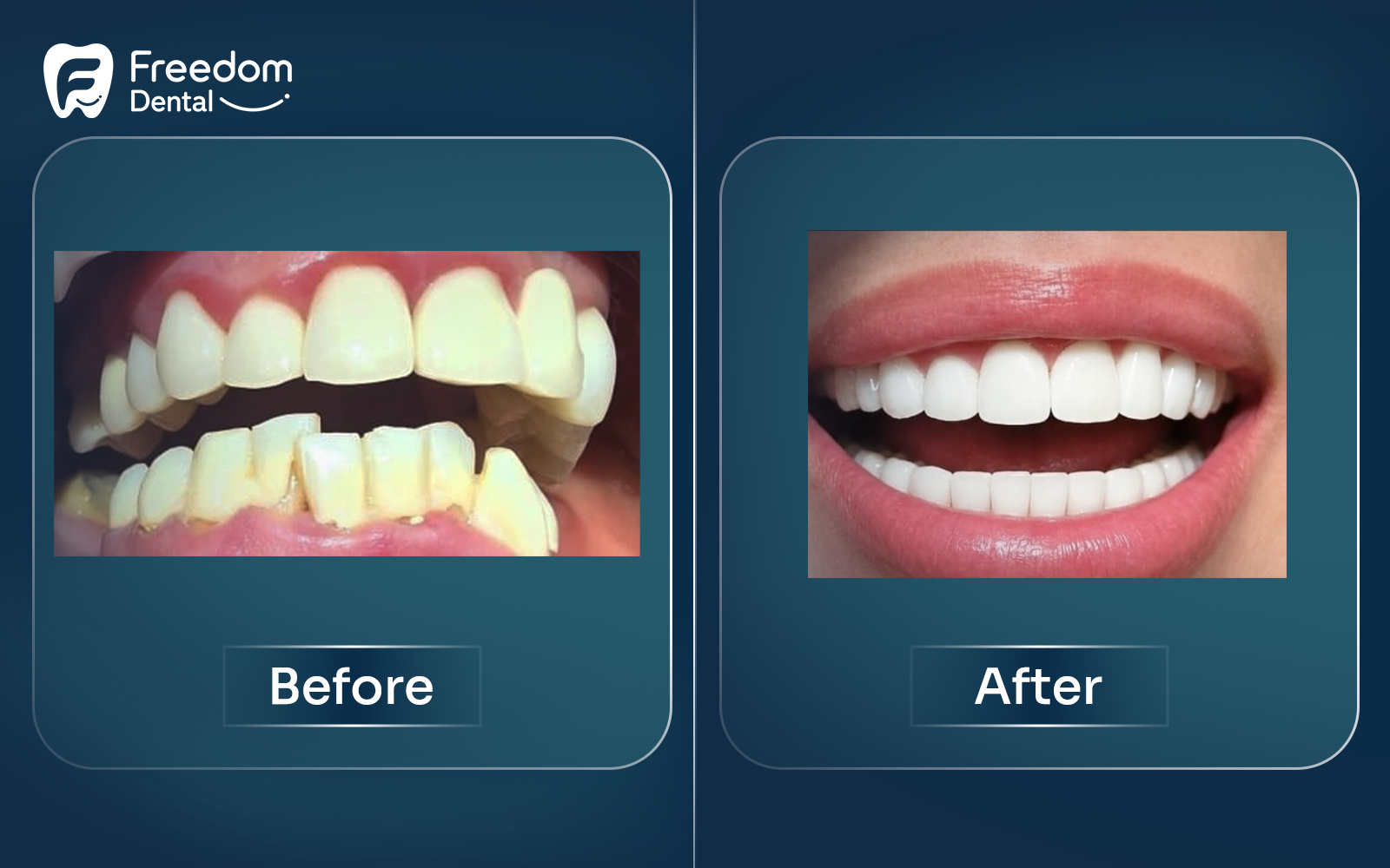 Zirconia Crowns