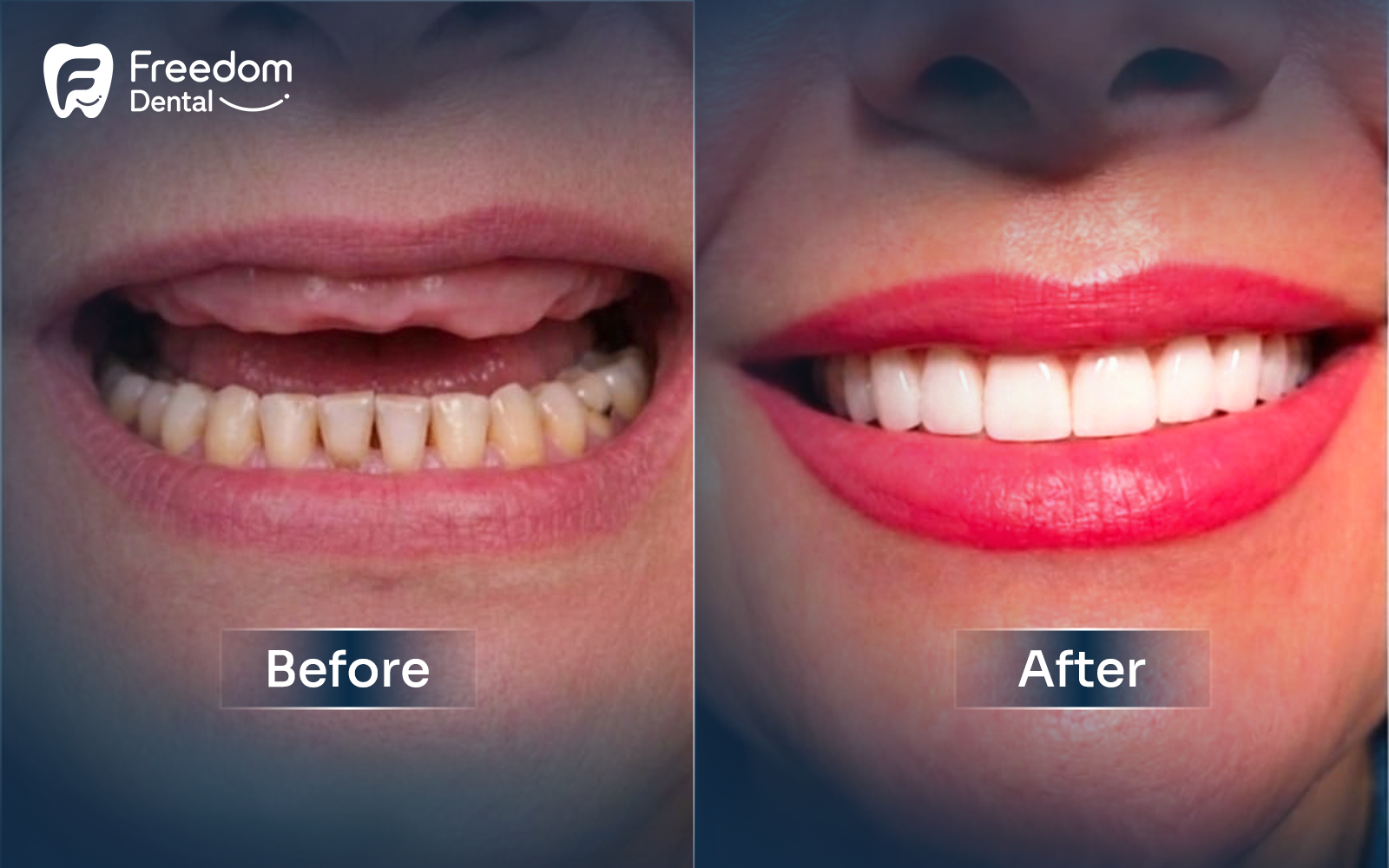 Full Dental Implants