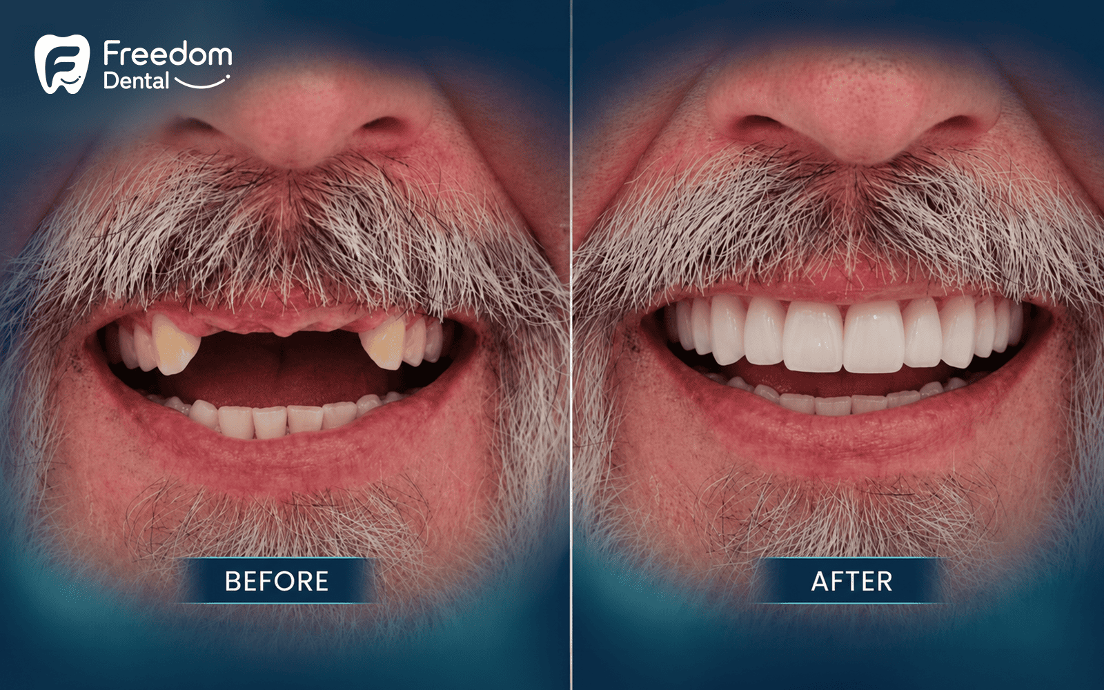 Treating Missing Front Teeth with Dental Implants