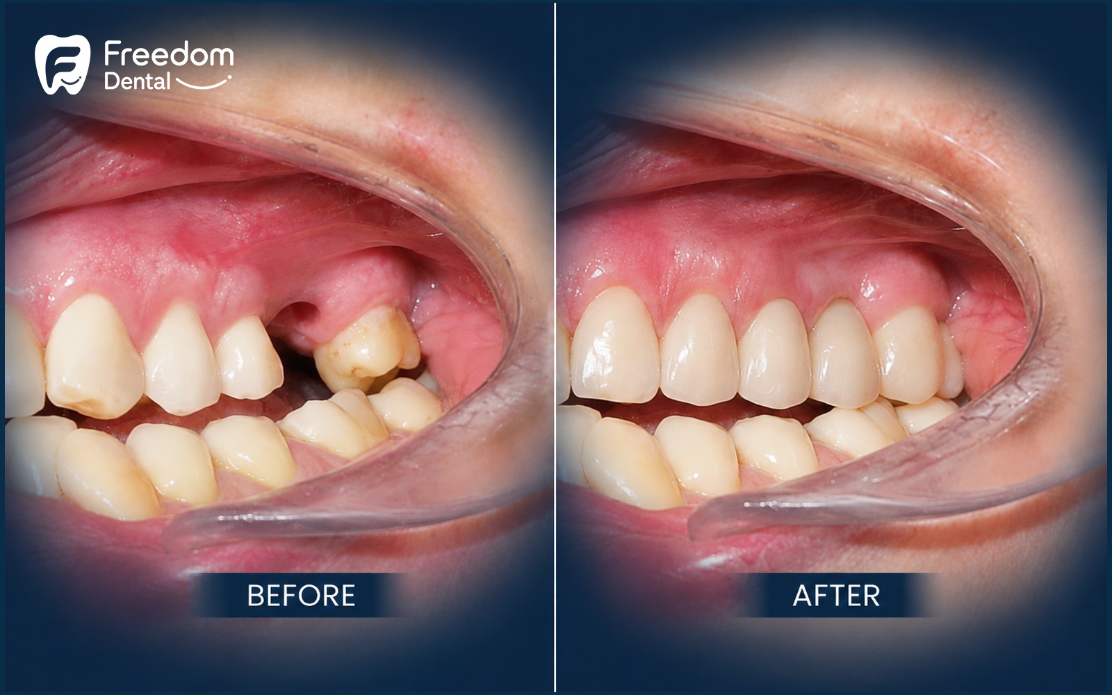 Replacing a missing upper left molar