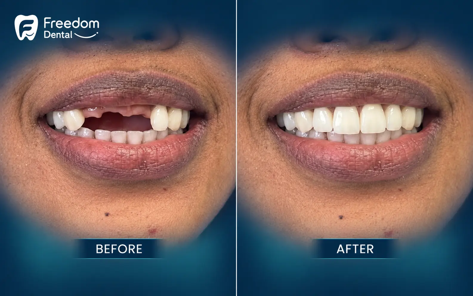 zirconia dental bridge Dublin