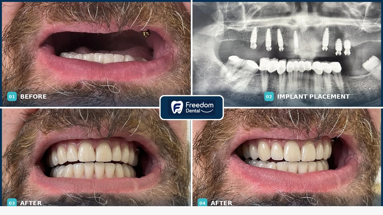 implant supported bridge Dublin