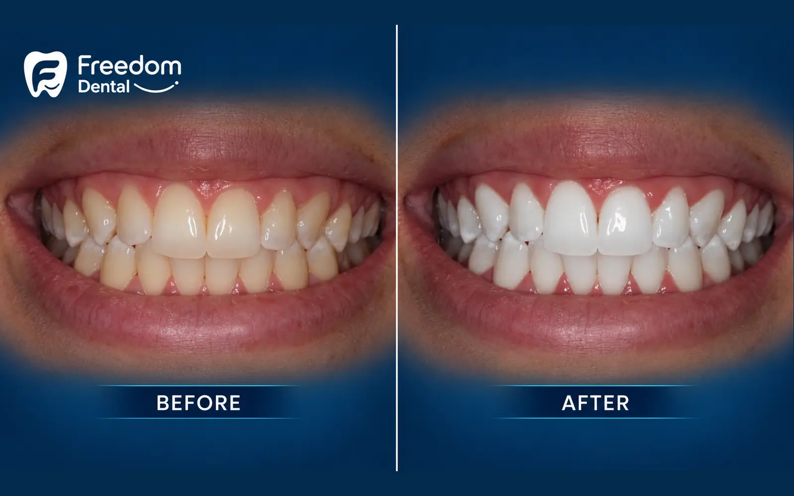 Smile White Teeth Whitening before and after at Freedom Dental Dublin