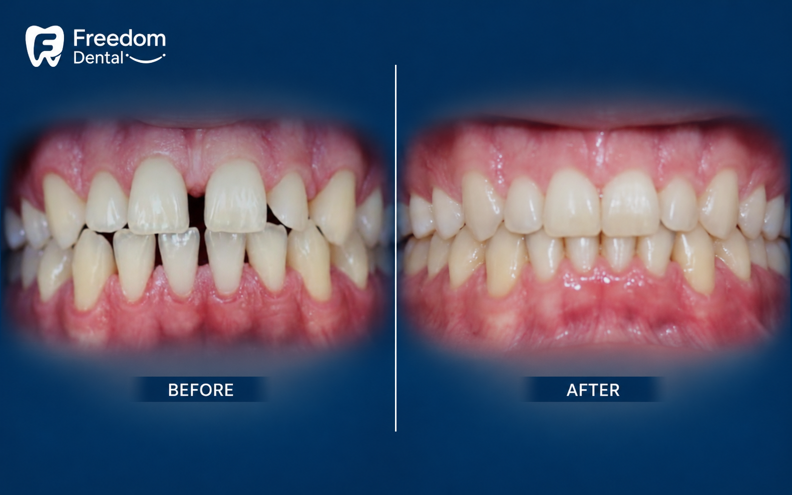 Invisalign Ireland