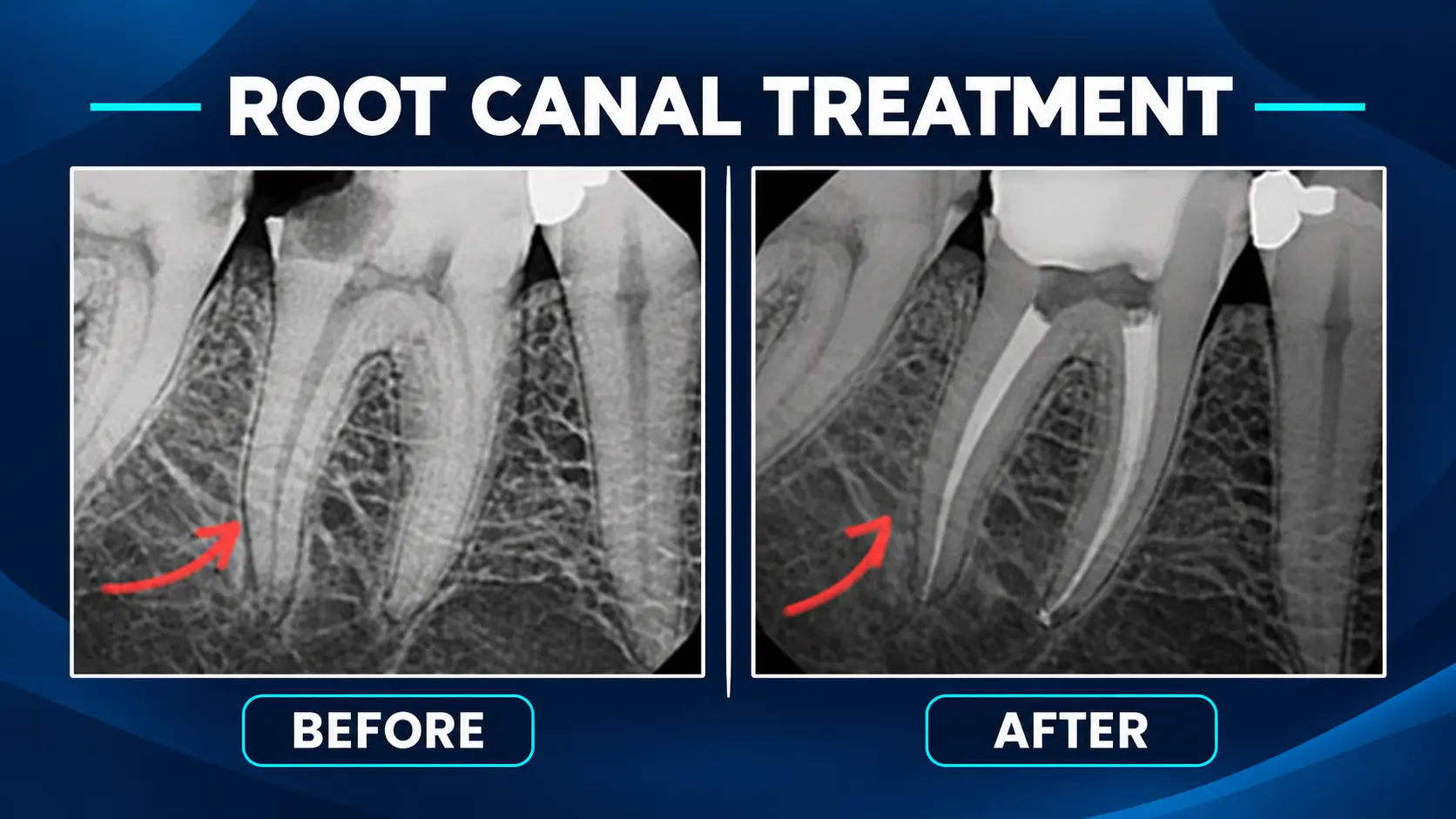 Root Canal Treatment Before and After Root Canal Treatment Before and After