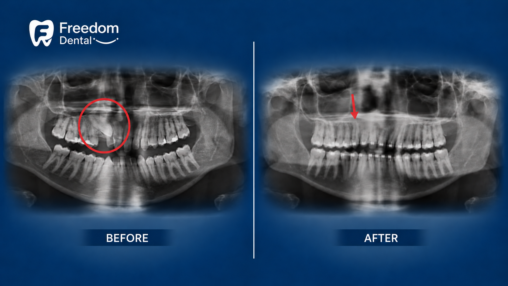 Surgical wisdom tooth extraction before and after