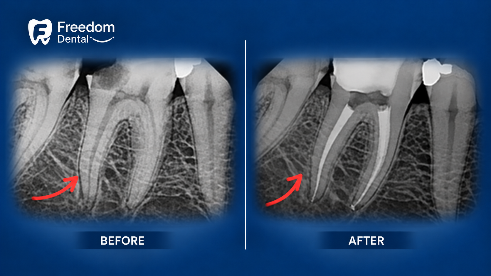 Root Canal Treatment Before and After